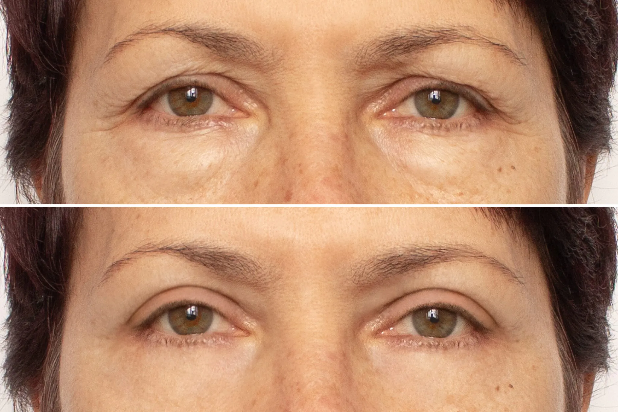 Blepharoplasty