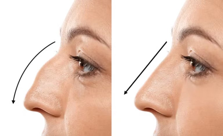 rhinoplasty-1-768x470-20260914150137-acef83