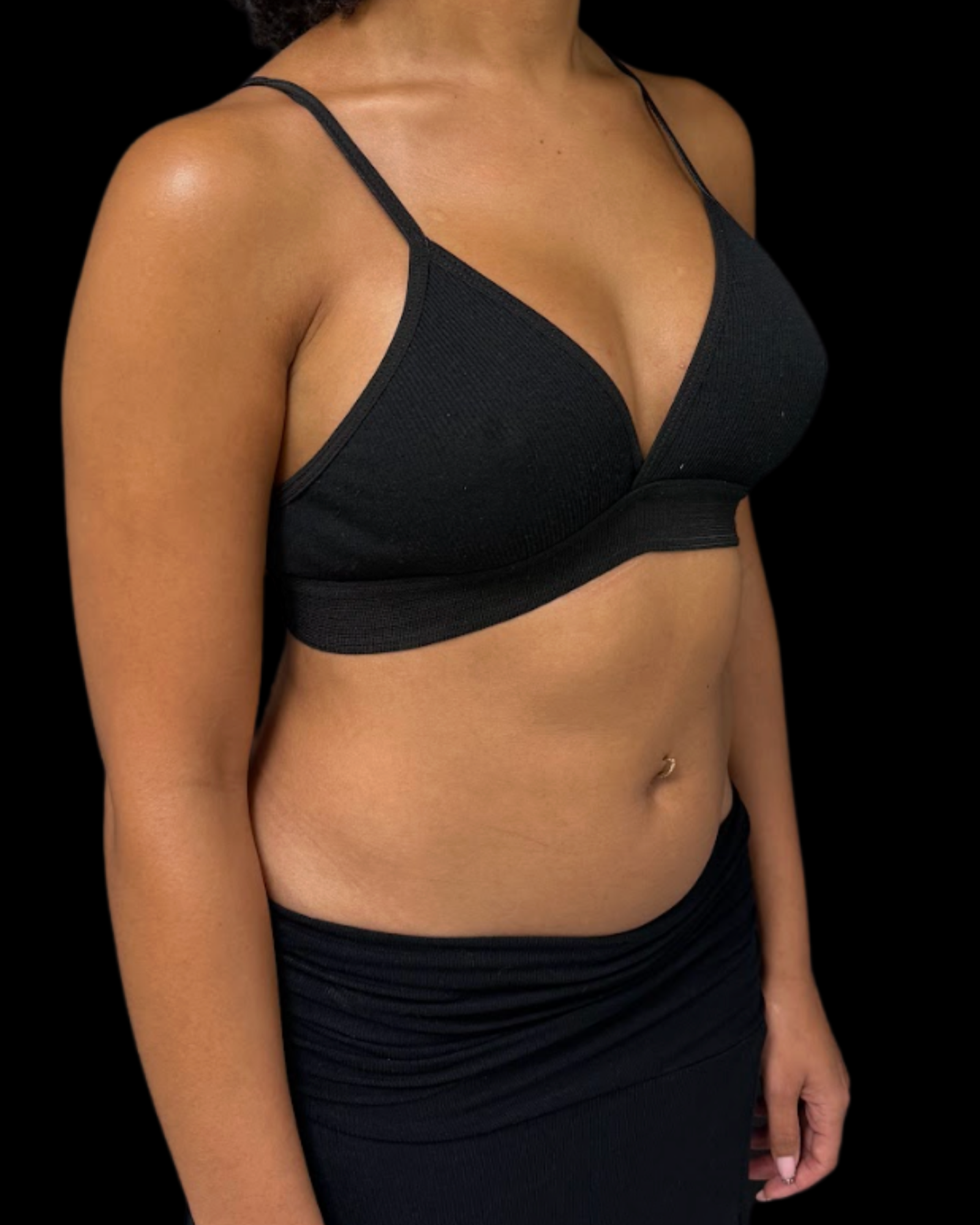 Breast Prosthesis Before
