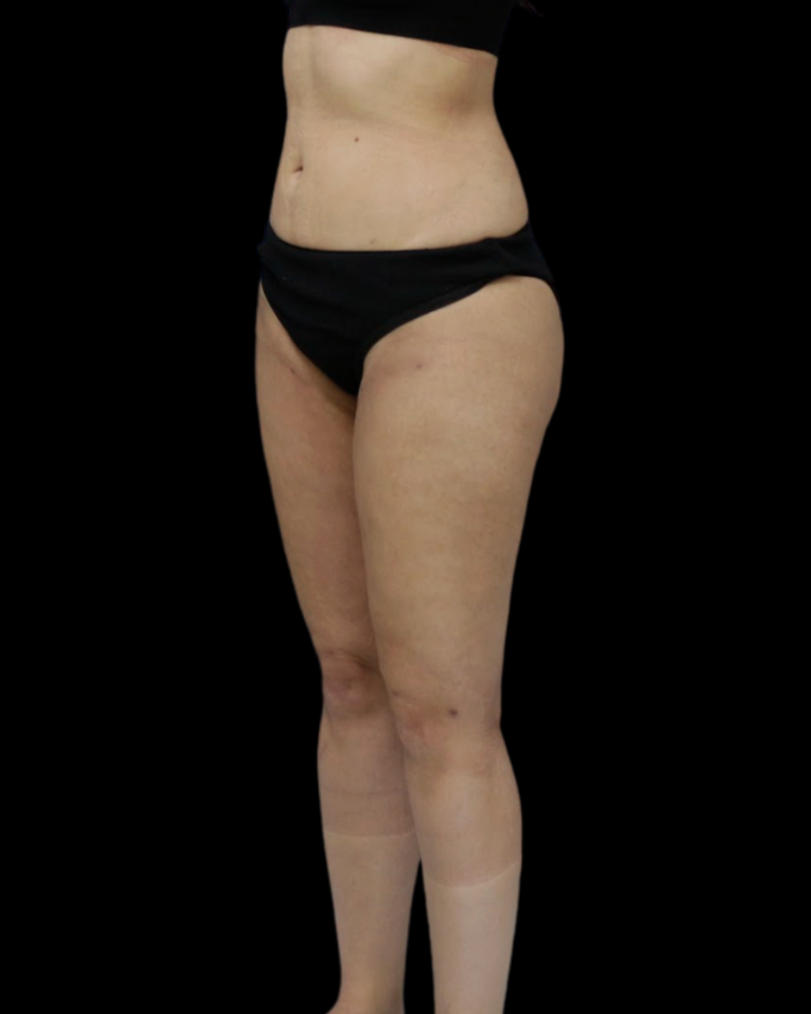 Liposuction After