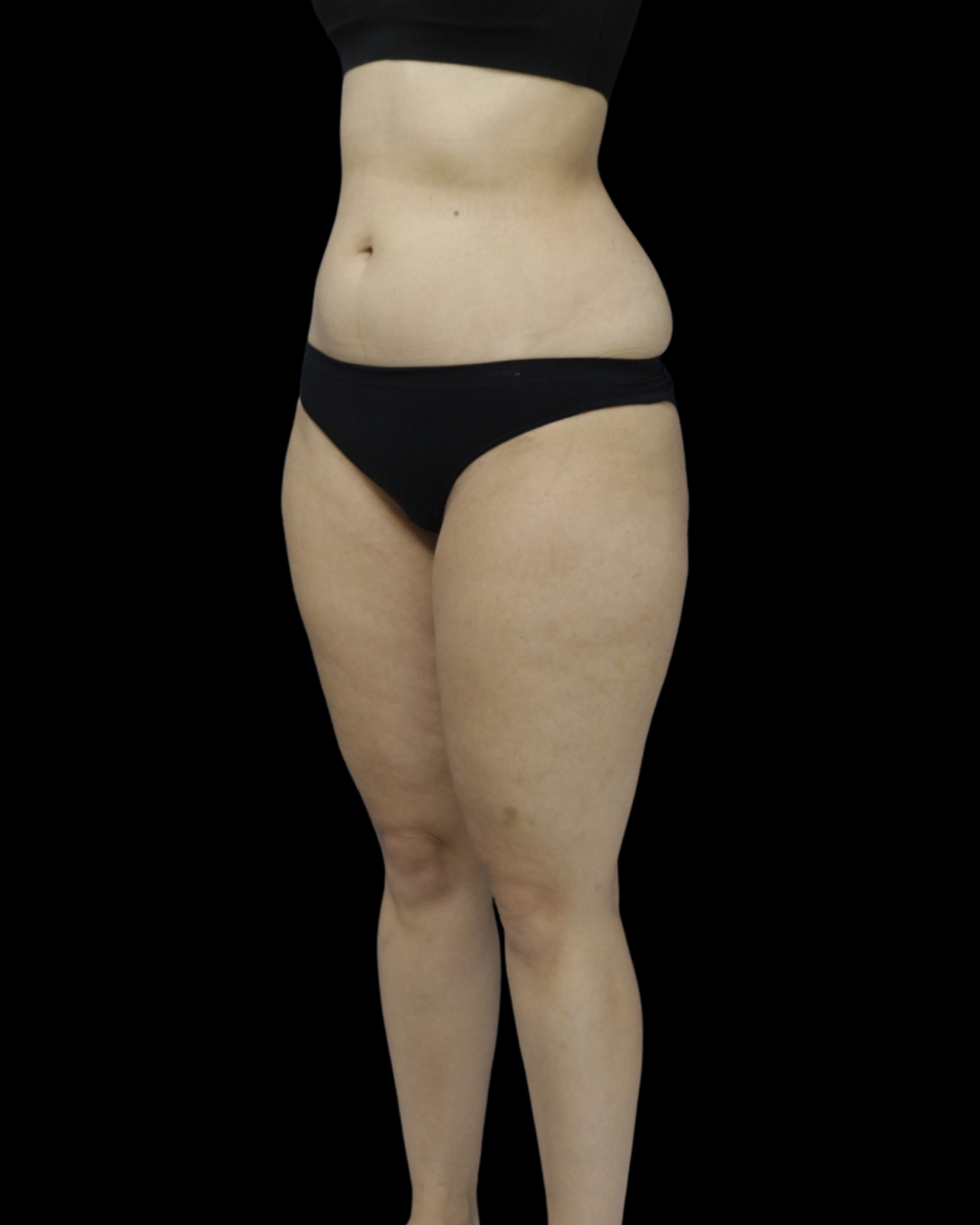 Liposuction Before
