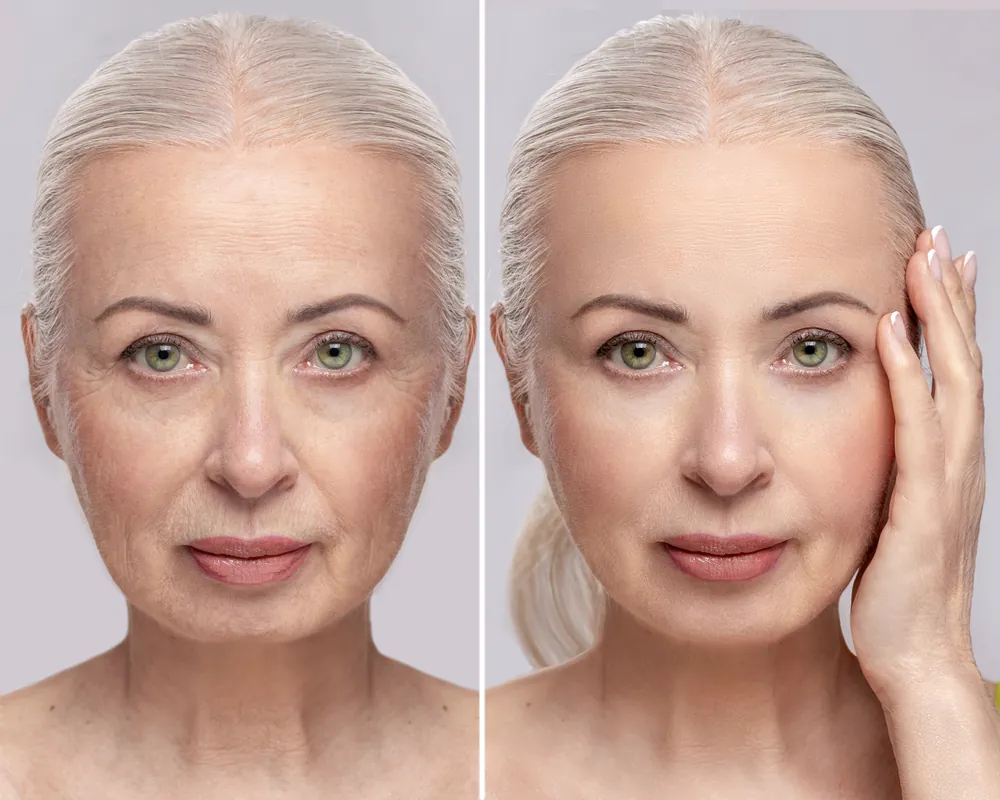 Facelift