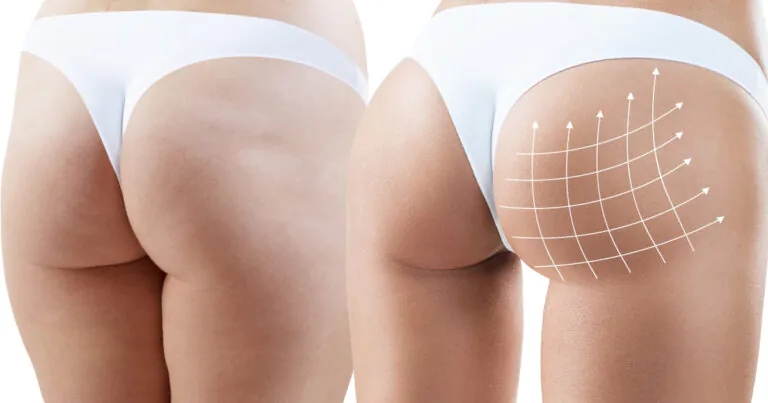 Gluteoplasty before and after contour