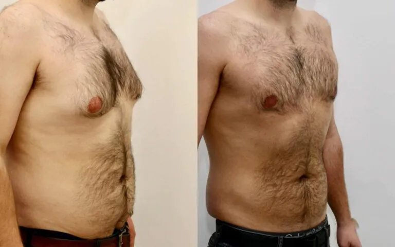 Gynecomastia correction before and after