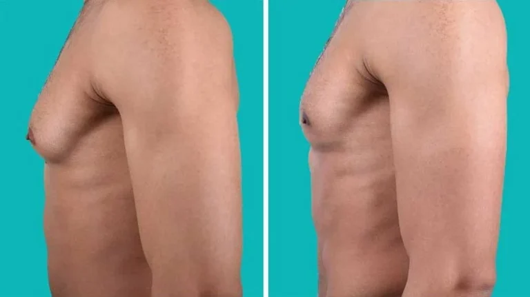Gynecomastia profile before and after