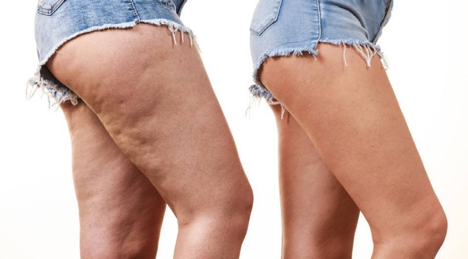 Lipedema