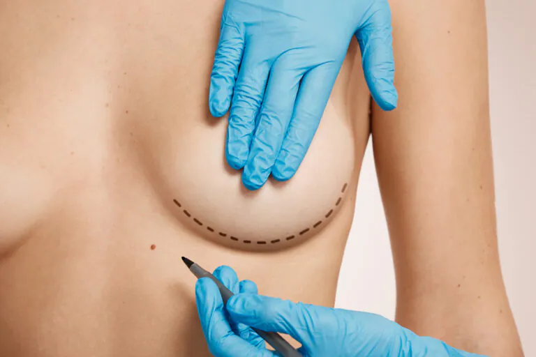 Mastopexy preoperative markings