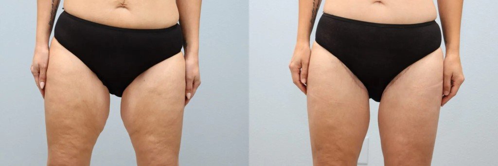 Thigh Lift