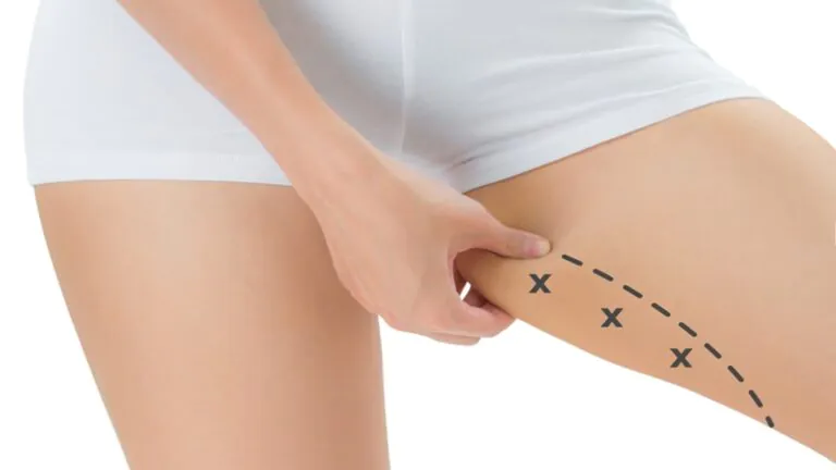 Inner thigh markings for thighplasty